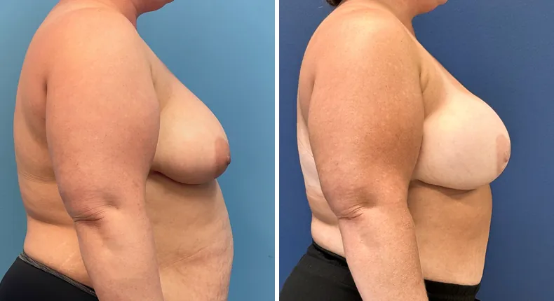 Before and after DIEP Flap: patient's breasts from the right side