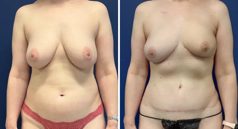 Before and after DIEP Flap: patient's breasts