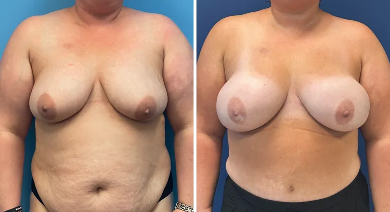 Before and after DIEP Flap: patient's breasts from the front