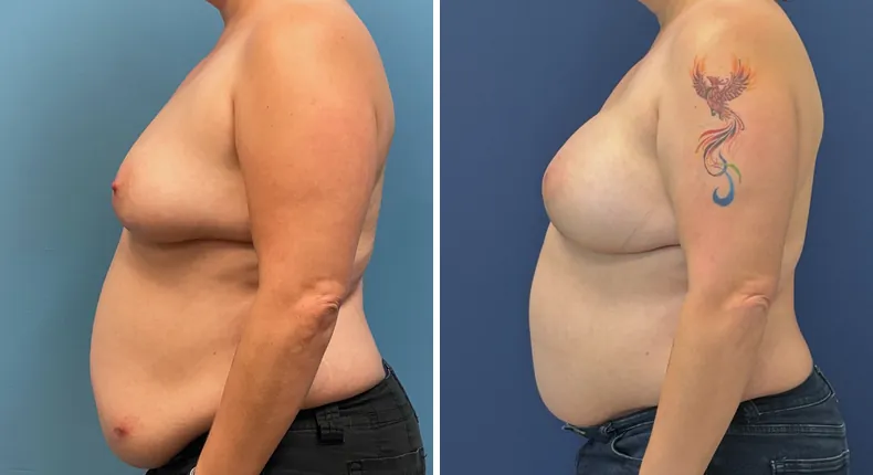 Before and after DIEP Flap: patient's breasts from the left side