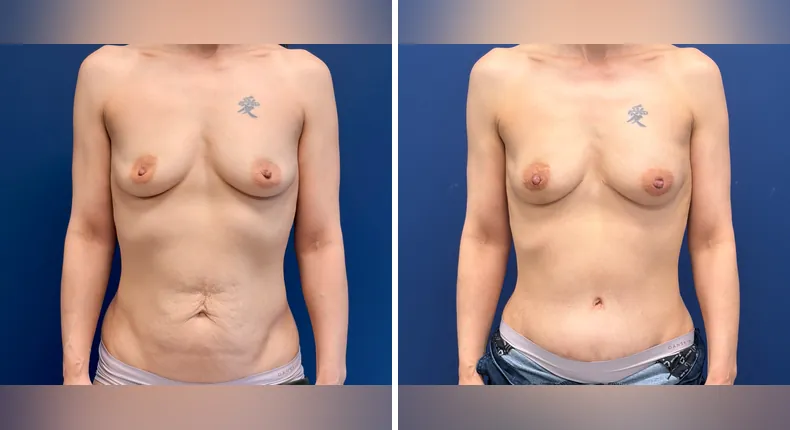 Before and after DIEP Flap: patient's breasts
