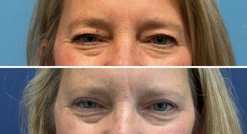 Before and after eyelid surgery: patient's eyes from the front