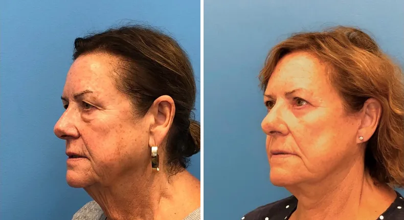 Before and after eyelid surgery: patient's eyes at a left angle, with facelift and neck lift