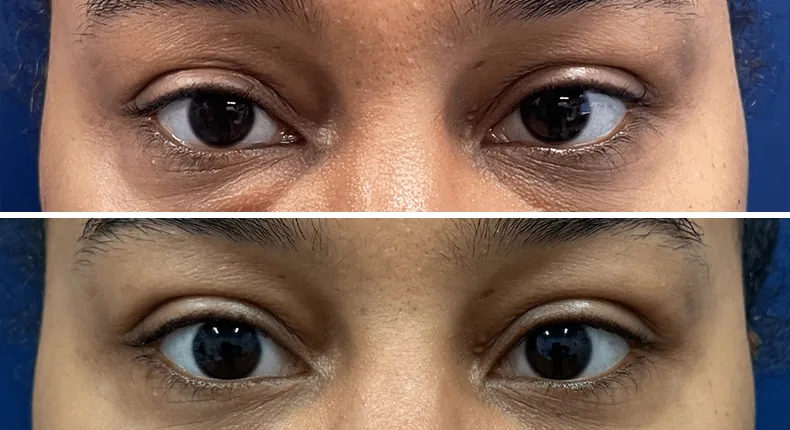 Before and after eyelid surgery: patient's eyes from the front