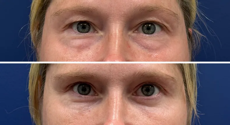 Before and after eyelid surgery: patient's eyes