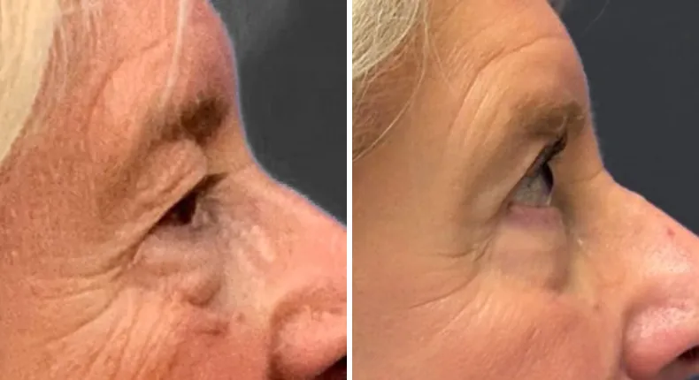Before and after eyelid surgery: patient's eyes from the right side