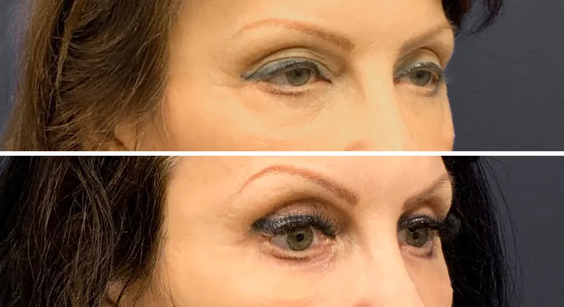 Before and after eyelid surgery: patient's eyes at a right angle