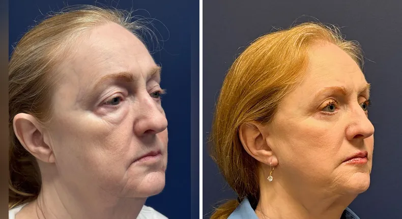 Before and after eyelid surgery: patient's eyes from the right side, with Face360, facelift, facial fat grafting and neck lift
