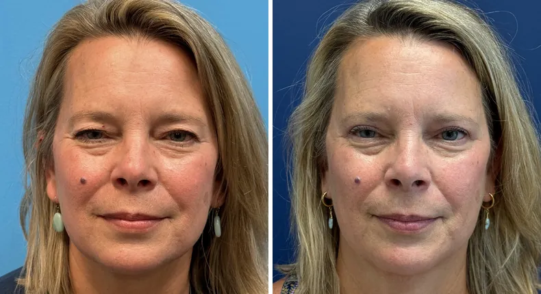 Before and after eyelid surgery: patient's eyes from the front