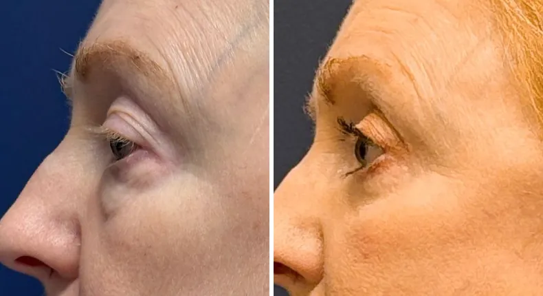 Before and after eyelid surgery: patient's eyes from the left side