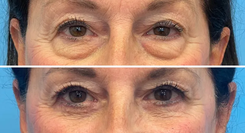 Before and after eyelid surgery: patient's eyes