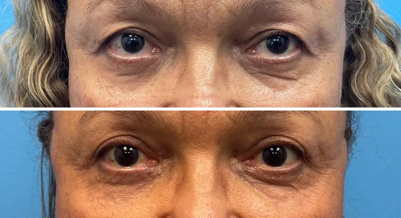 Before and after eyelid surgery: patient's eyes