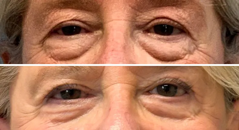 Before and after eyelid surgery: patient's eyes from the front