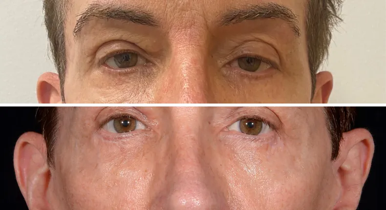 Before and after eyelid surgery: patient's eyes