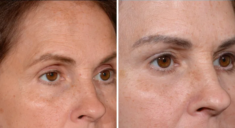 Before and after eyelid surgery: patient's eyes at a right angle