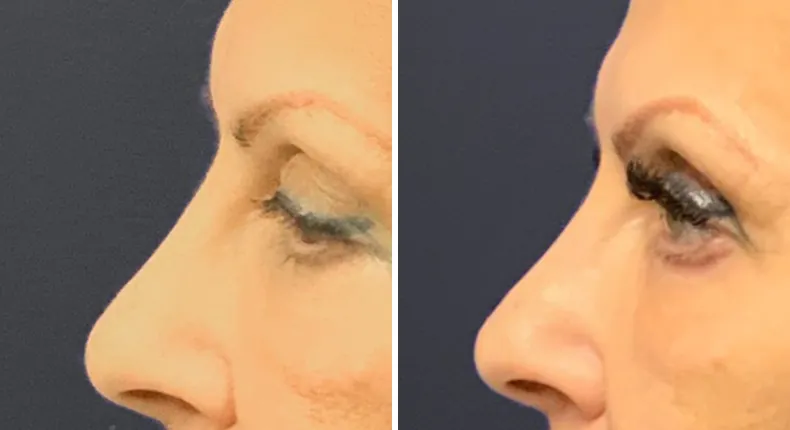 Before and after eyelid surgery: patient's eyes from the left side