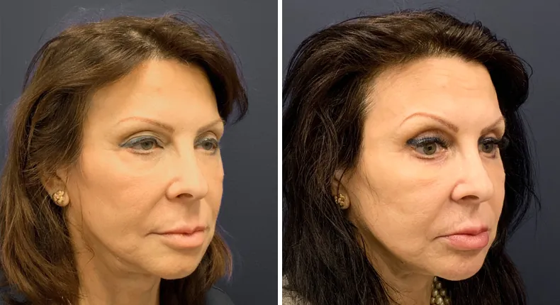 Before and after eyelid surgery: patient's eyes at a right angle