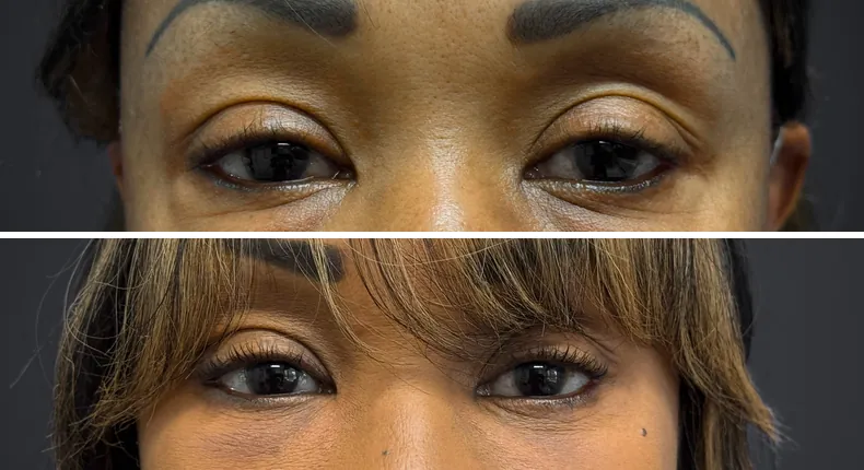 Before and after eyelid surgery: patient's eyes, with facelift