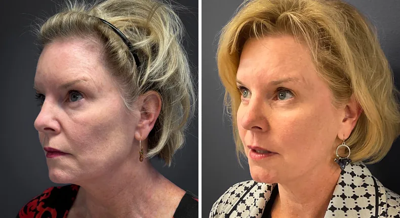 Before and after eyelid surgery: patient's eyes at a left angle
