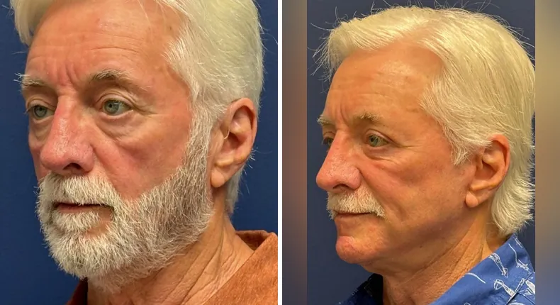 Before and after eyelid surgery: patient's eyes from the left side, with Face360, facelift, facial fat grafting and neck lift