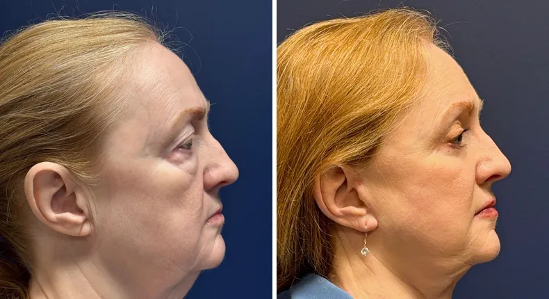 Before and after eyelid surgery: patient's eyes from the right side, with Face360, facelift, facial fat grafting and neck lift