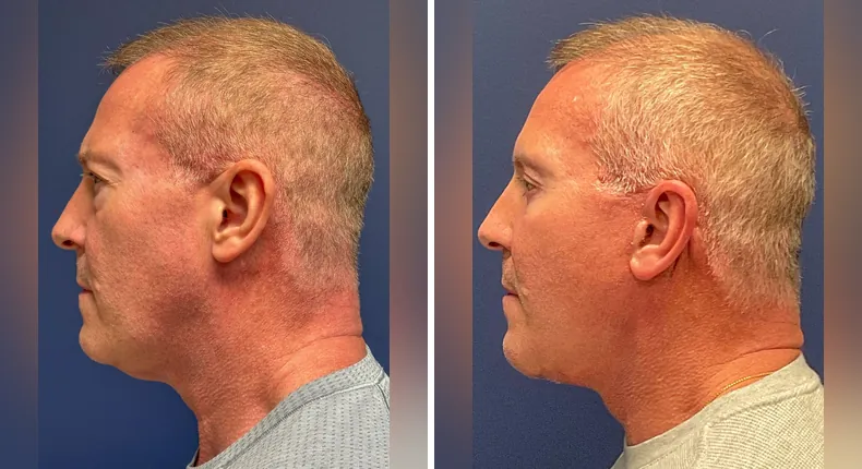 Before and after eyelid surgery: patient's eyes from the left side, with Face360, facelift and neck lift