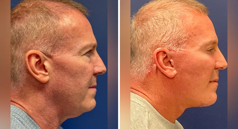 Before and after eyelid surgery: patient's eyes from the right side, with Face360, facelift and neck lift