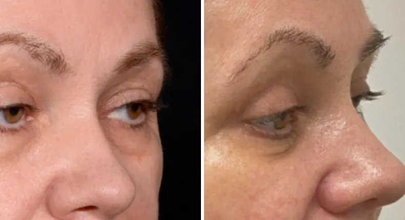 Before and after eyelid surgery: patient's eyes at a right angle