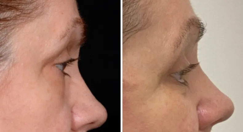 Before and after eyelid surgery: patient's eyes in right profile