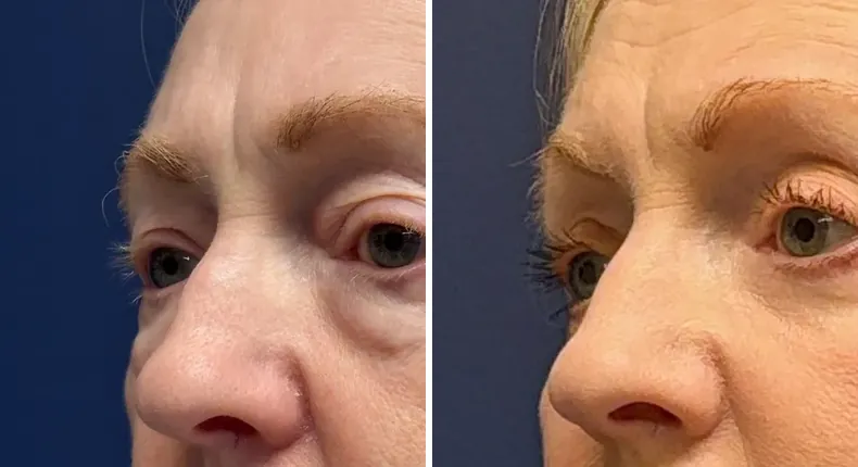 Before and after eyelid surgery: patient's eyes from the left side