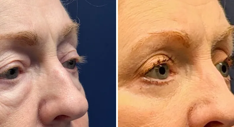 Before and after eyelid surgery: patient's eyes from the right side