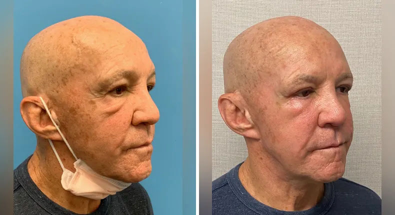 Before and after eyelid surgery: woman's eyes at a right angle