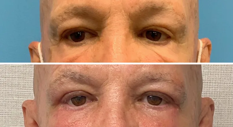 Before and after eyelid surgery: woman's eyes