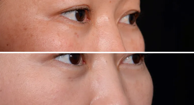 Before and after eyelid surgery: patient's eyes at a right angle