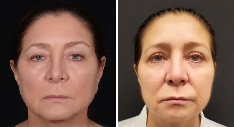 Before and after eyelid surgery: patient's eyes from the front