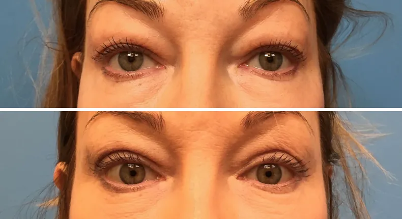 Before and after eyelid surgery: patient's eyes
