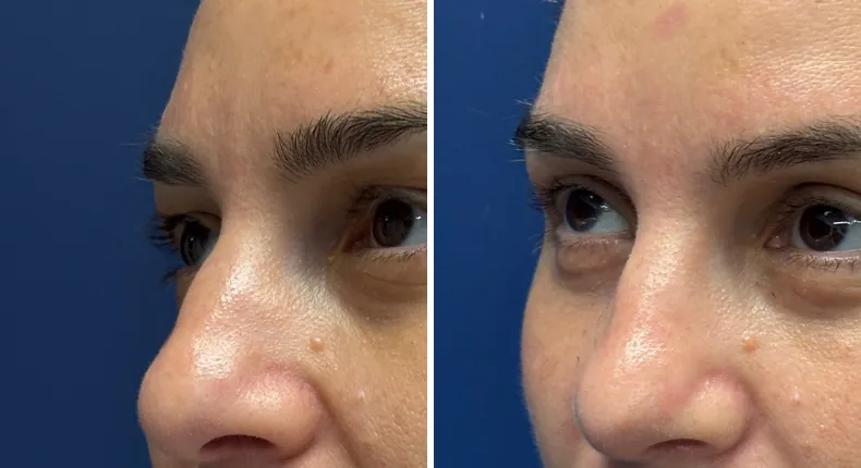 Before and after eyelid surgery: patient's eyes from the left side