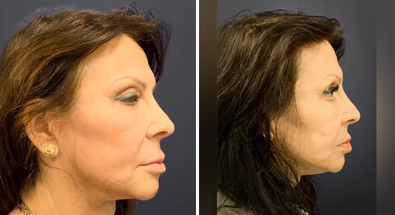 Before and after eyelid surgery: patient's eyes from the right side