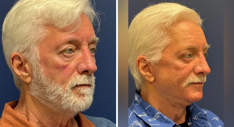 Before and after eyelid surgery: patient's eyes from the right side, with Face360, facelift, facial fat grafting and neck lift