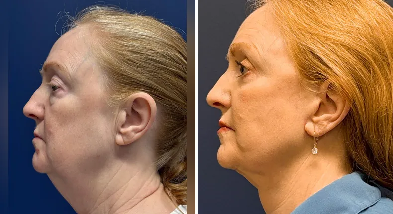 Before and after eyelid surgery: patient's eyes from the left side, with Face360, facelift, facial fat grafting and neck lift