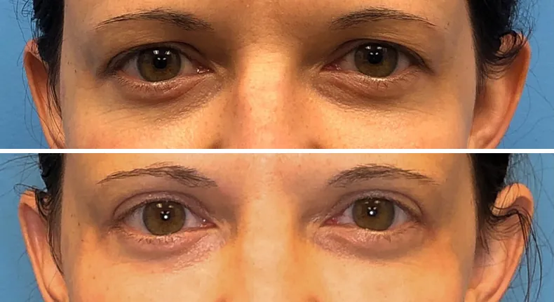 Before and after eyelid surgery: patient's eyes