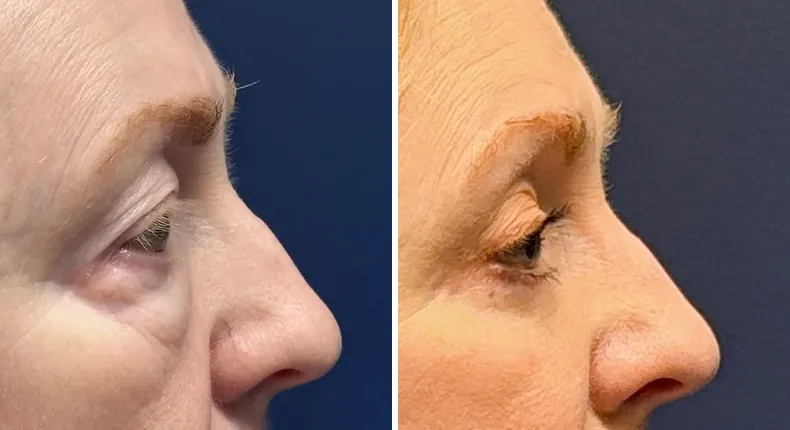 Before and after eyelid surgery: patient's eyes from the right side