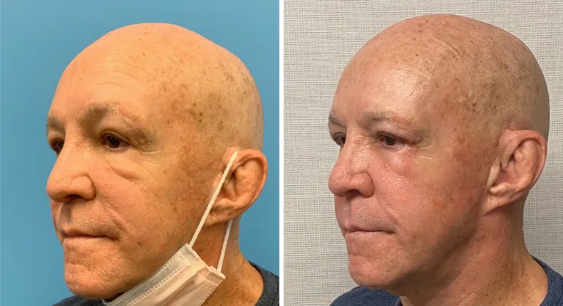 Before and after eyelid surgery: woman's eyes at a left angle