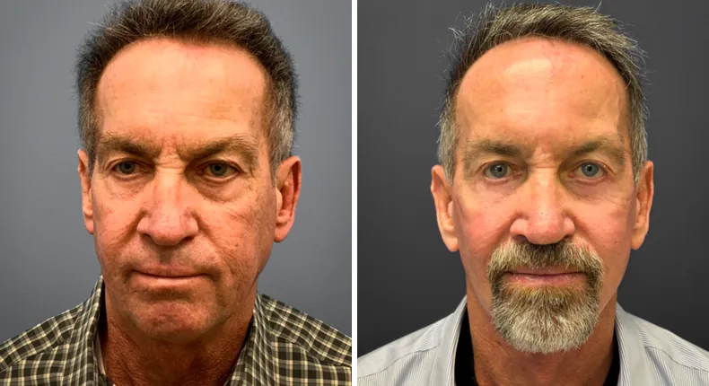 Before and after eyelid surgery: man's eyes from the front, with facelift and rhinoplasty