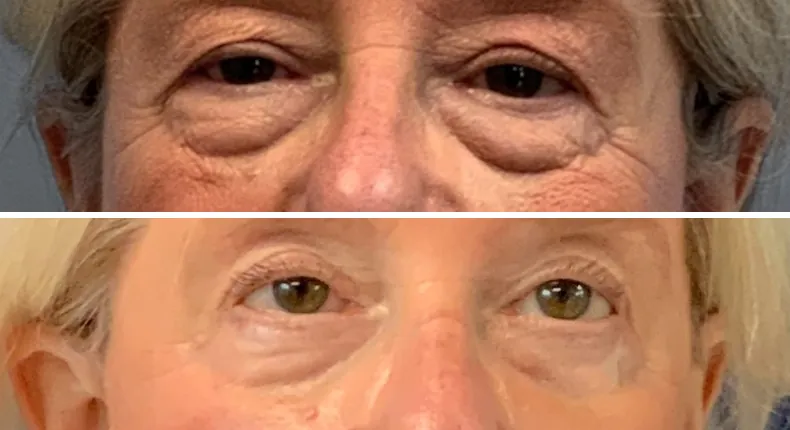 Before and after eyelid surgery: patient's eyes from the front