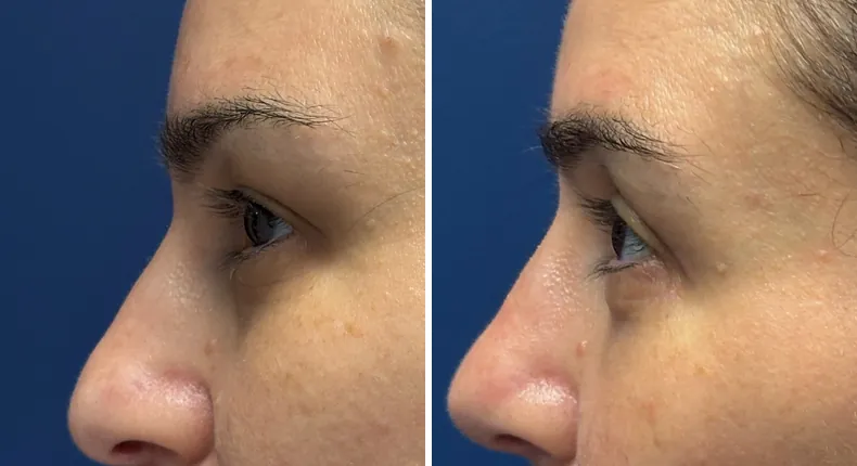 Before and after eyelid surgery: patient's eyes from the left side