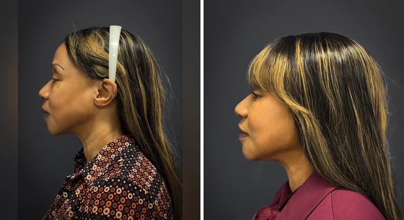 Before and after eyelid surgery: patient's eyes from the left side, with facelift
