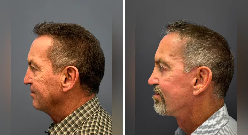 Before and after eyelid surgery: man's eyes in left profile, with facelift and rhinoplasty