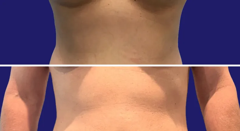 Before and after eyelid surgery: man's eyes, with liposuction