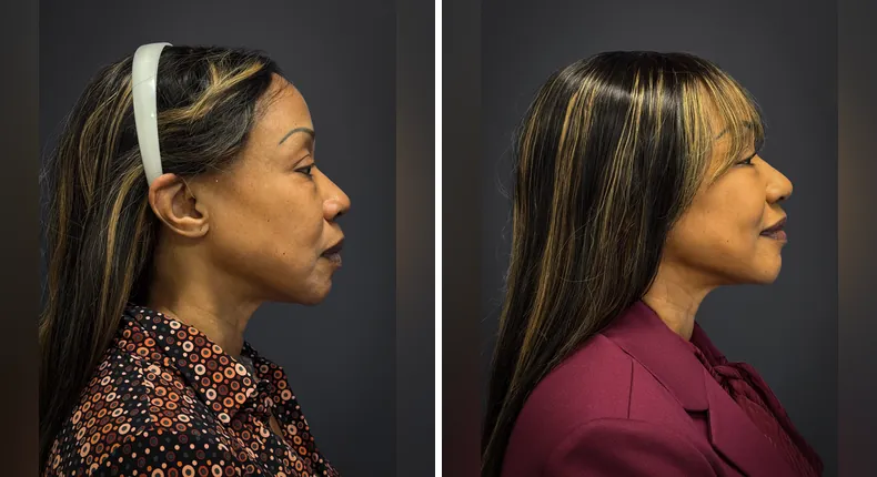 Before and after eyelid surgery: patient's eyes from the right side, with facelift